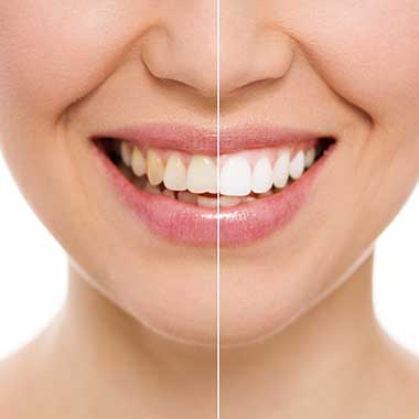 Teeth Whitening in Pahrump